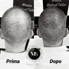 Immagine 6 azienda TRICOPIGMENTAZIONE E MICROBLANDING - DR MONICA SECCA Tatuaggio e piercing in Roma