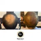Immagine 8 azienda TRICOPIGMENTAZIONE E MICROBLANDING - DR MONICA SECCA Tatuaggio e piercing in Roma